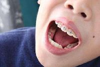 【健康解碼】矯正牙齒真的可以瘦臉嗎？